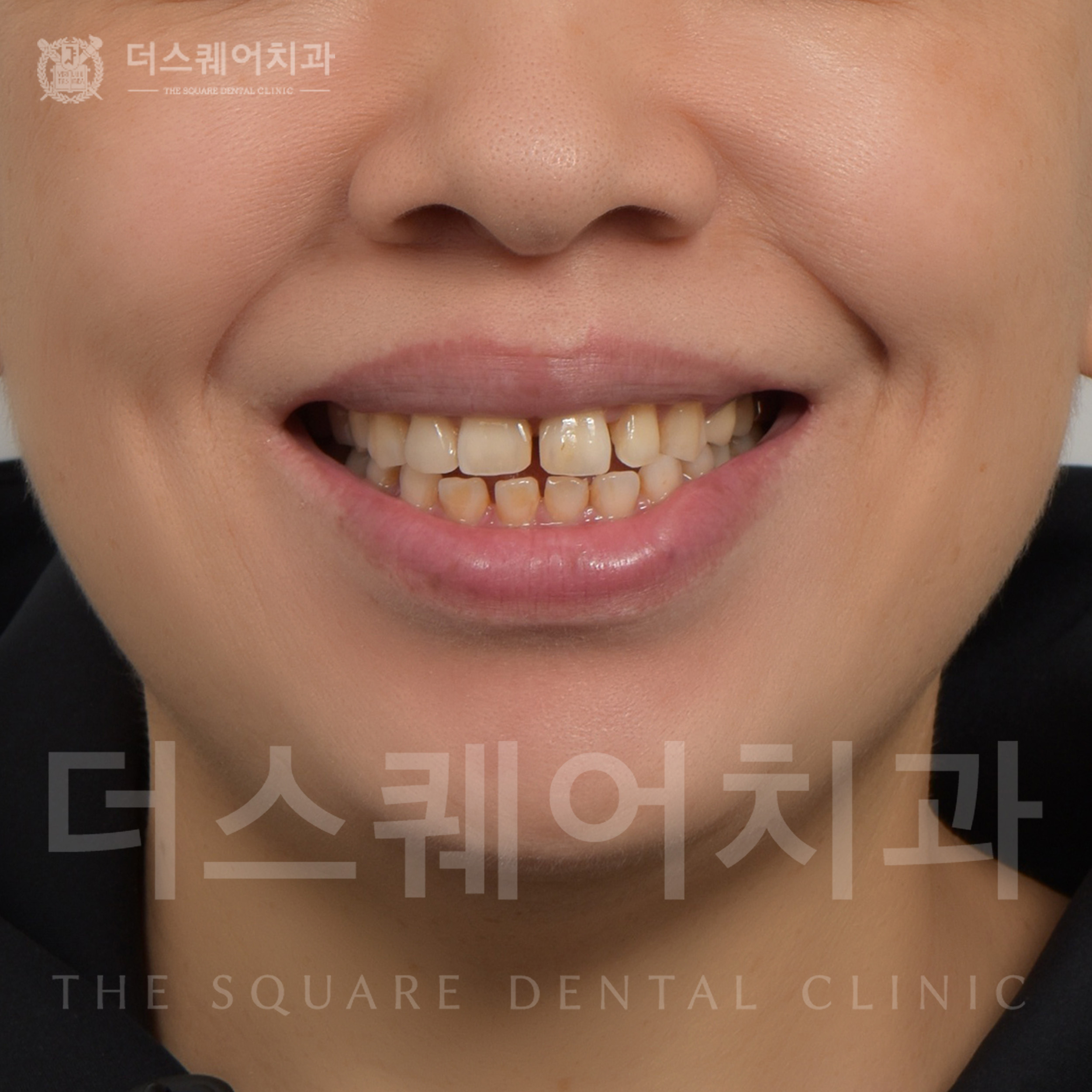 손상, 변색, 벌어진 치아 복구를 위한 미니쉬 심미치료
