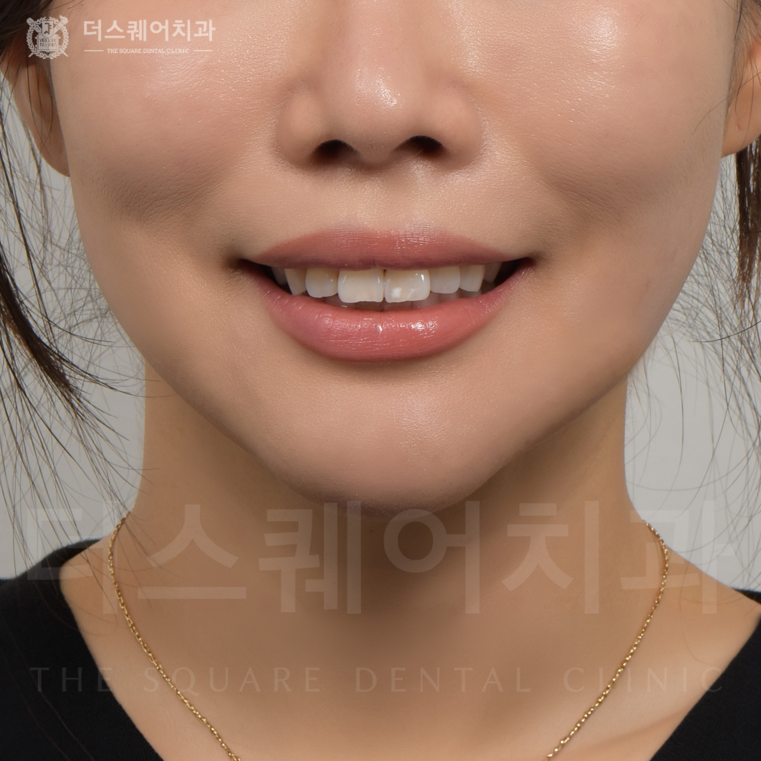 변색, 손상된 치아복구를 위한 미니쉬 심미치료