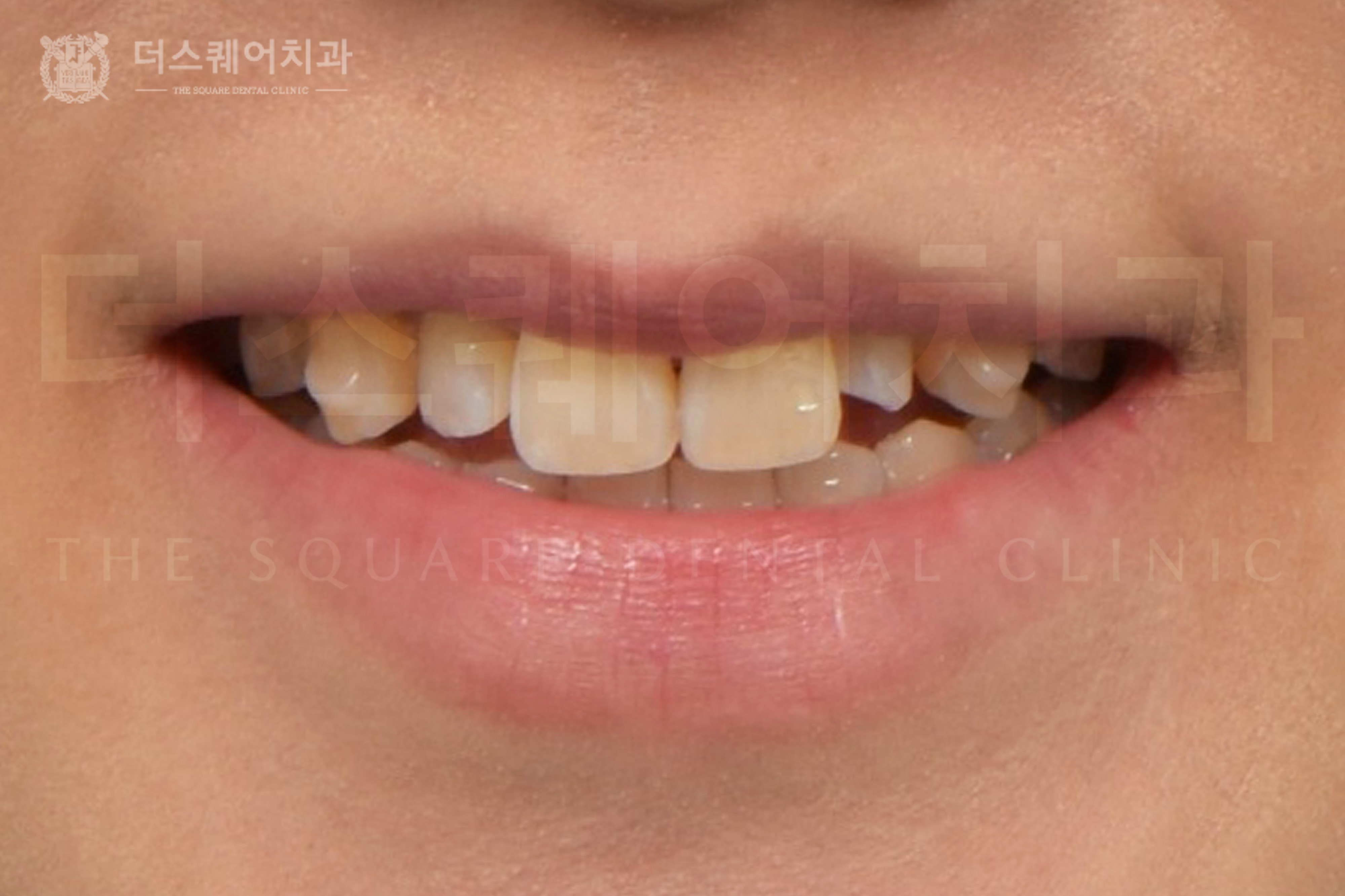 왜소치 개선을 위한 미니쉬 심미 치료