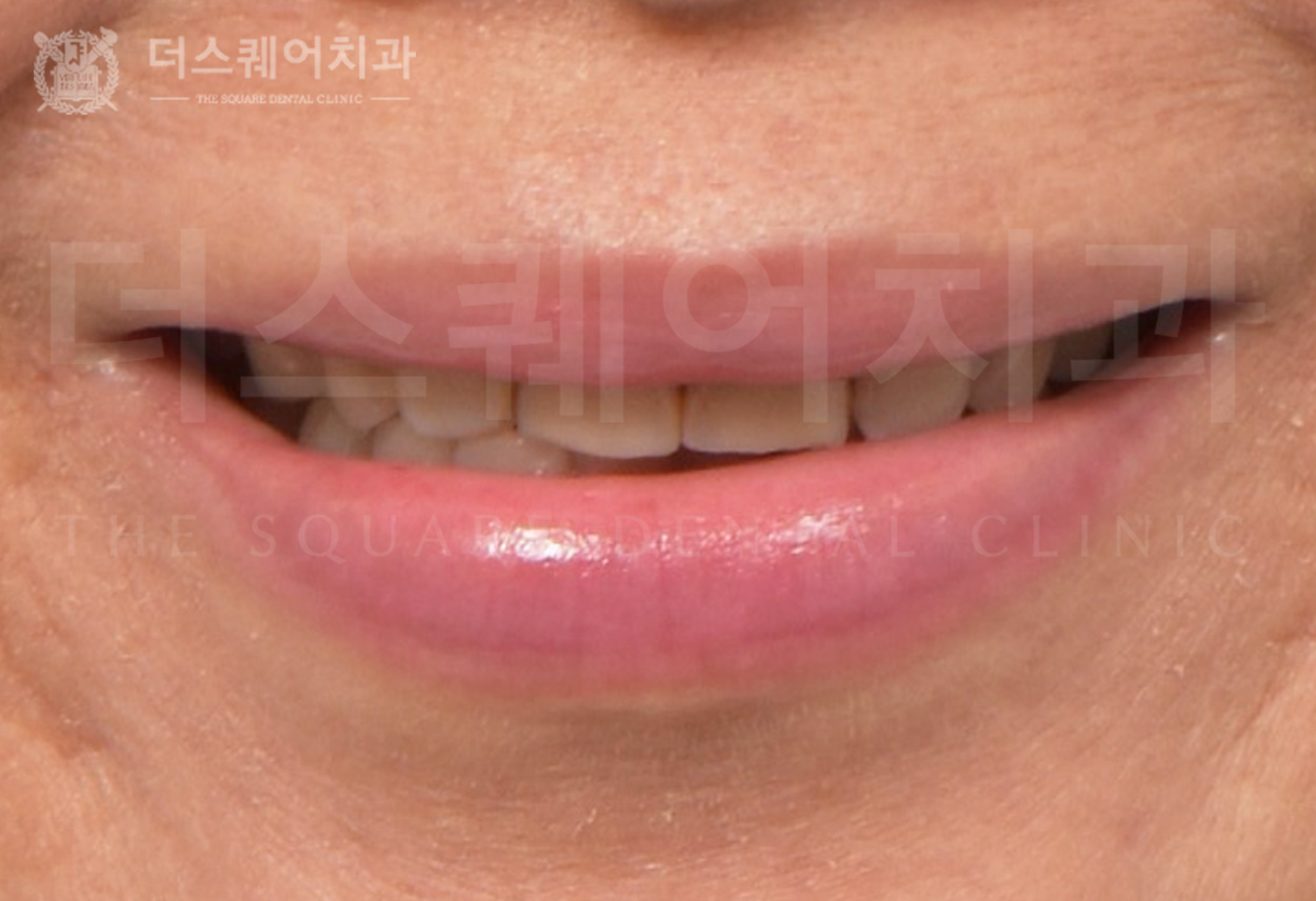 변색, 손상된 치아를 미니쉬로 치아복구