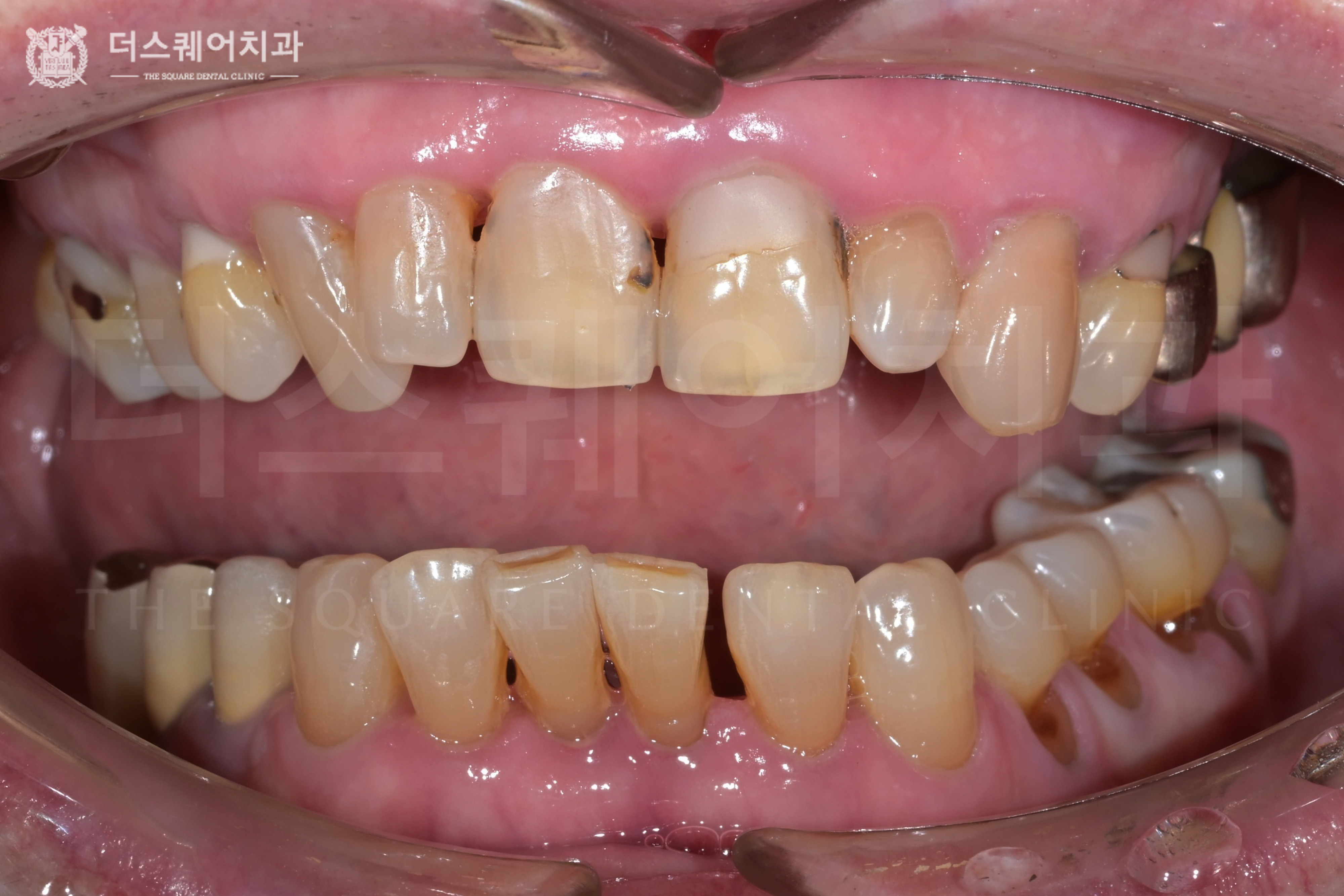 손상, 변색, 블랙 트라이앵글, 벌어진 치아 복구를 위한 미니쉬 심미치료