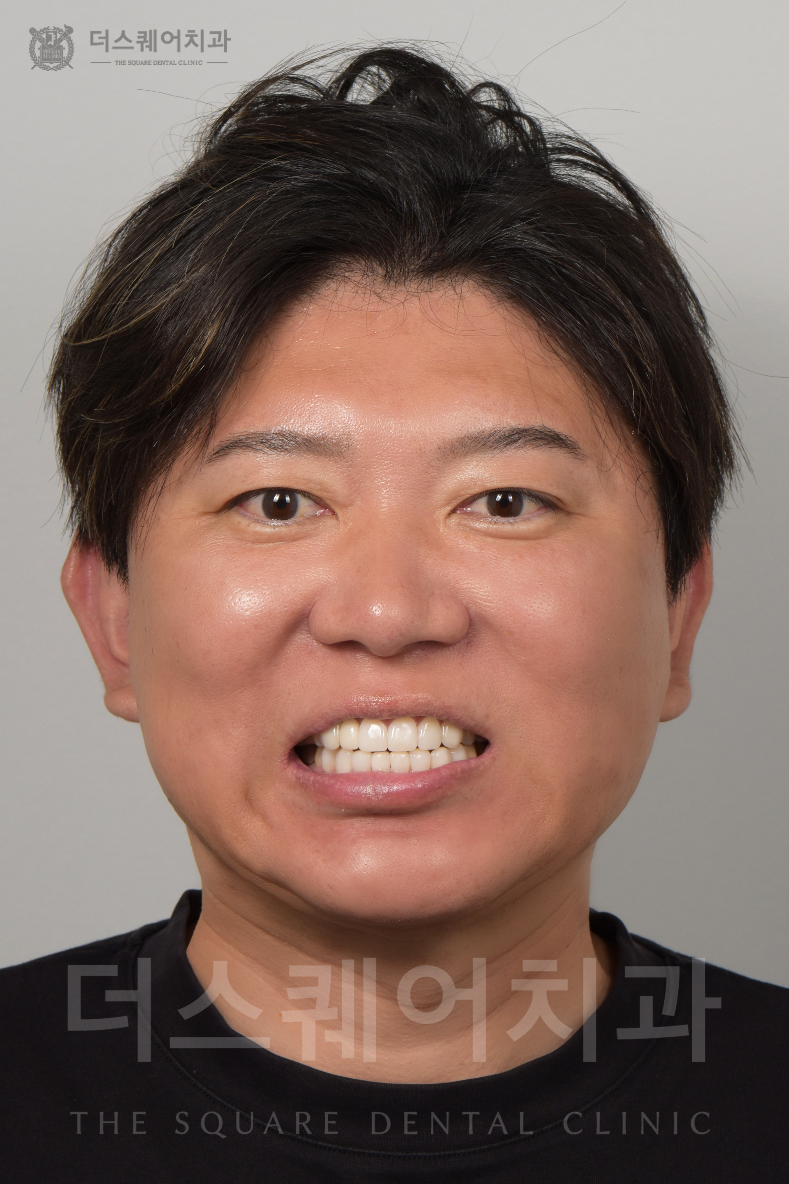 덧니, 배열, 변색된 치아 복구를 위한 비니어큐브 심미치료
