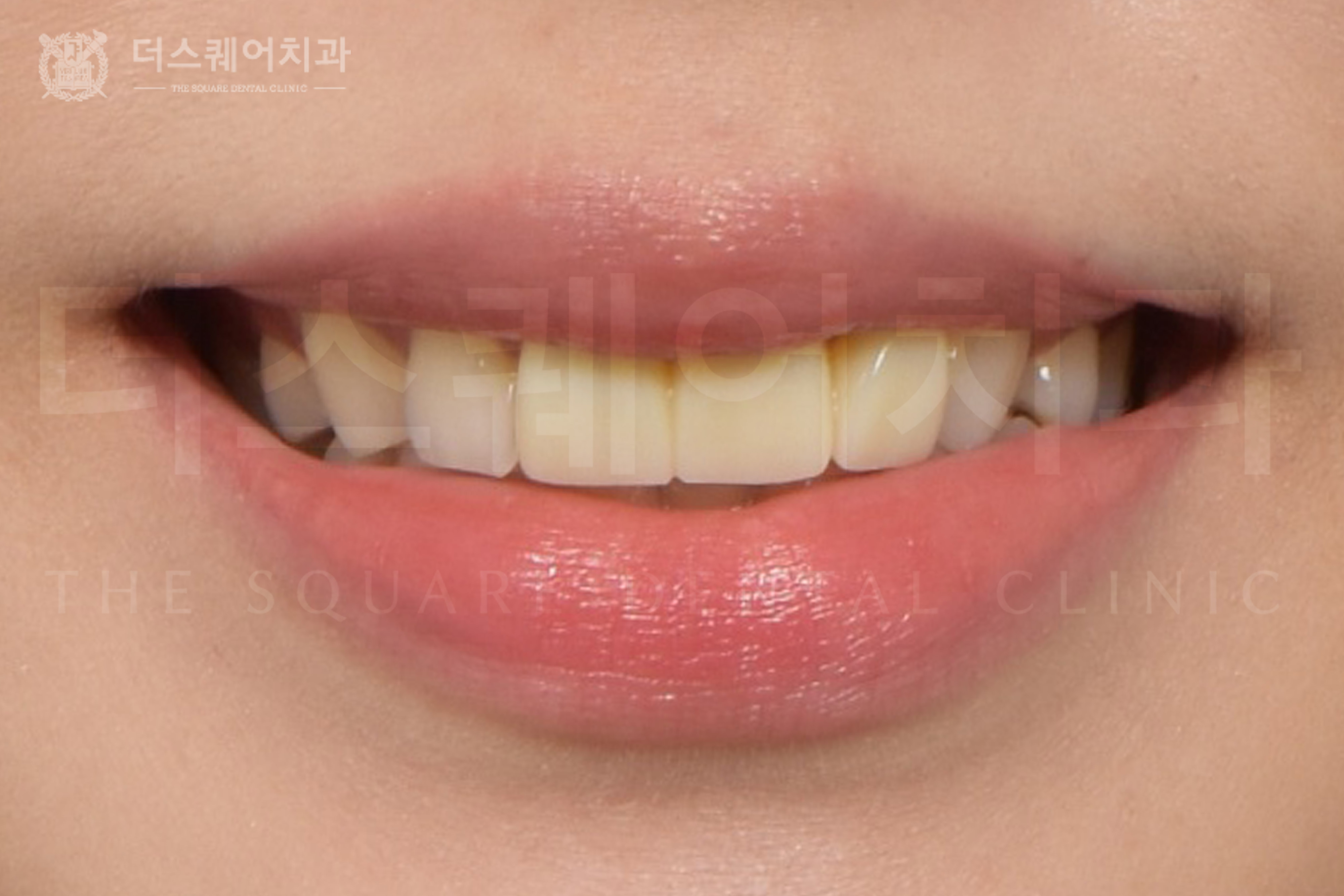 미니쉬 앞니재치료