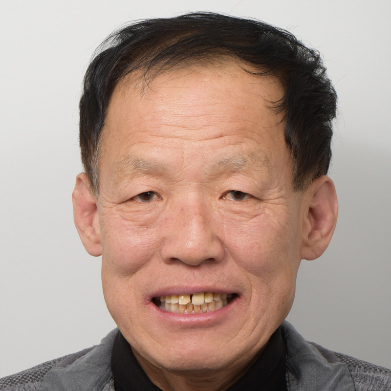 손상된 치아, 미니쉬로 치아복구