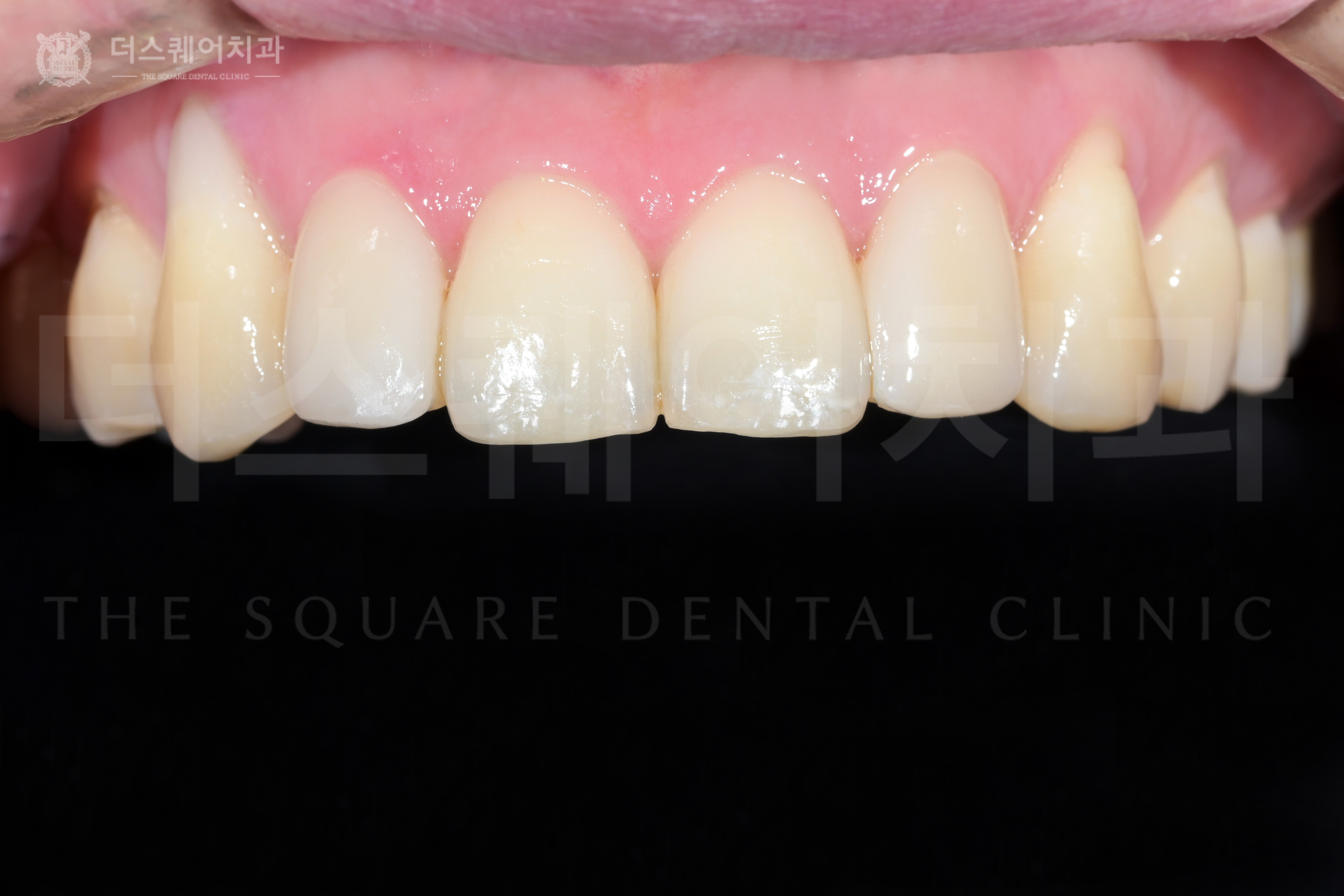 <br />
<b>Warning</b>:  Undefined variable $ba_title in <b>/home/thesquaredc.co.kr/clinical-case/clinicalcase.php</b> on line <b>608</b><br />
