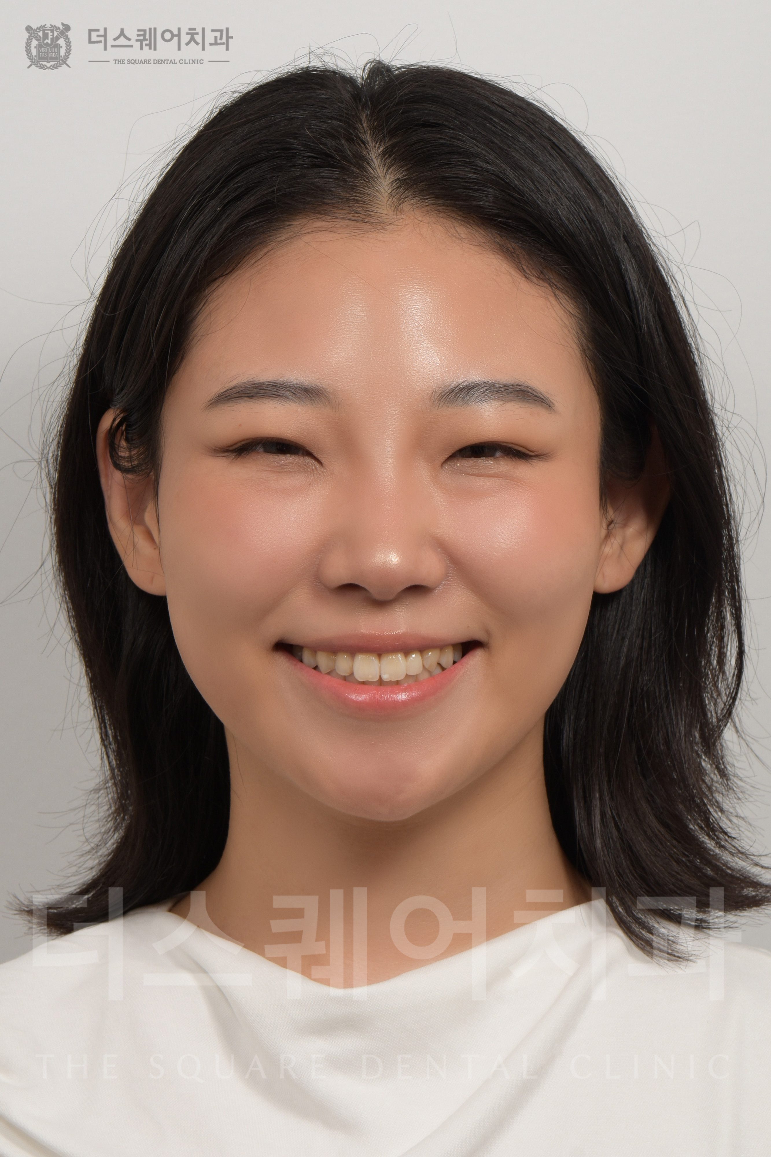 변색, 손상된 치아 복구를 위한 비니어큐브 심미치료