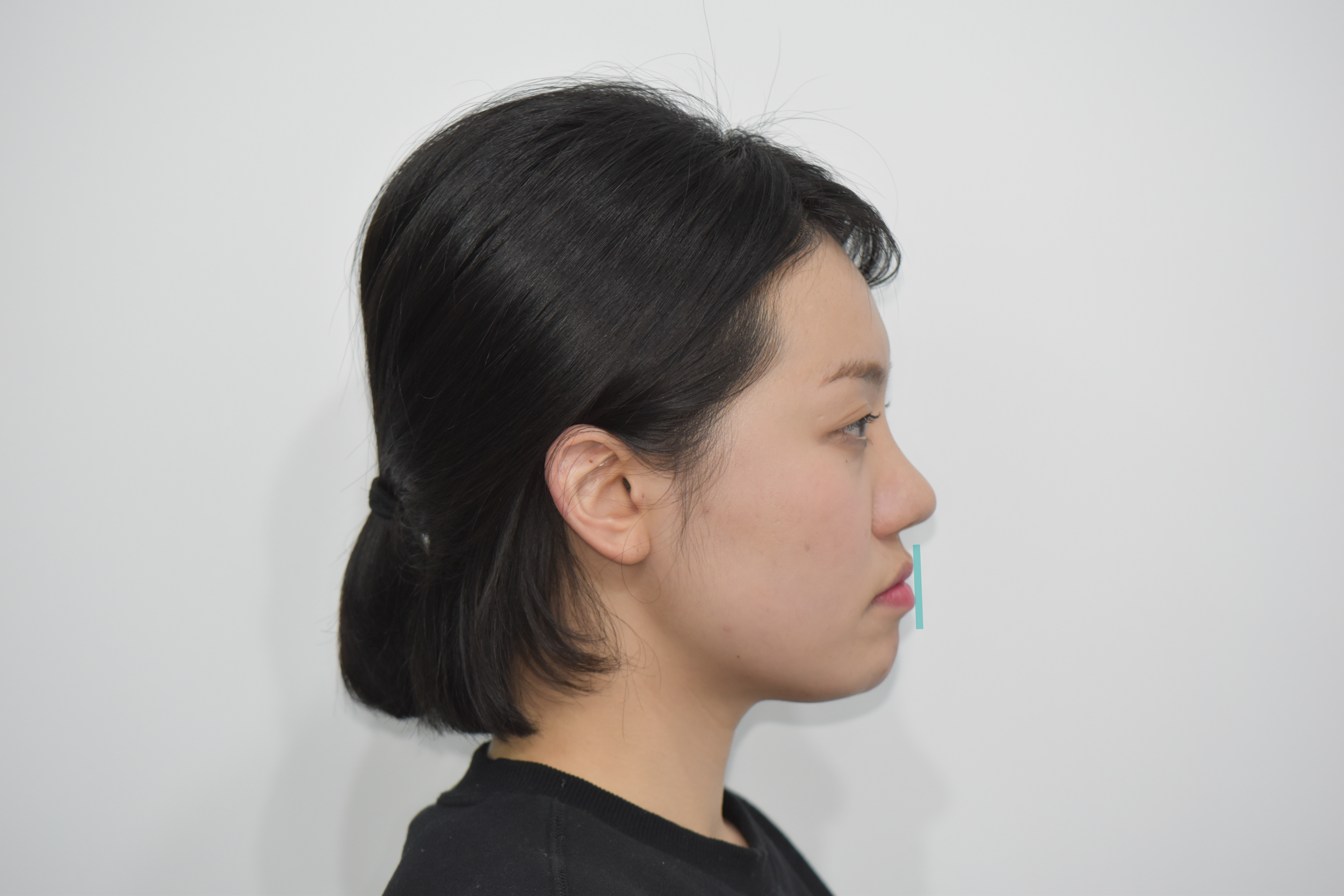 인비절라인 오리지널 투명교정 이야기를 준비중입니다.