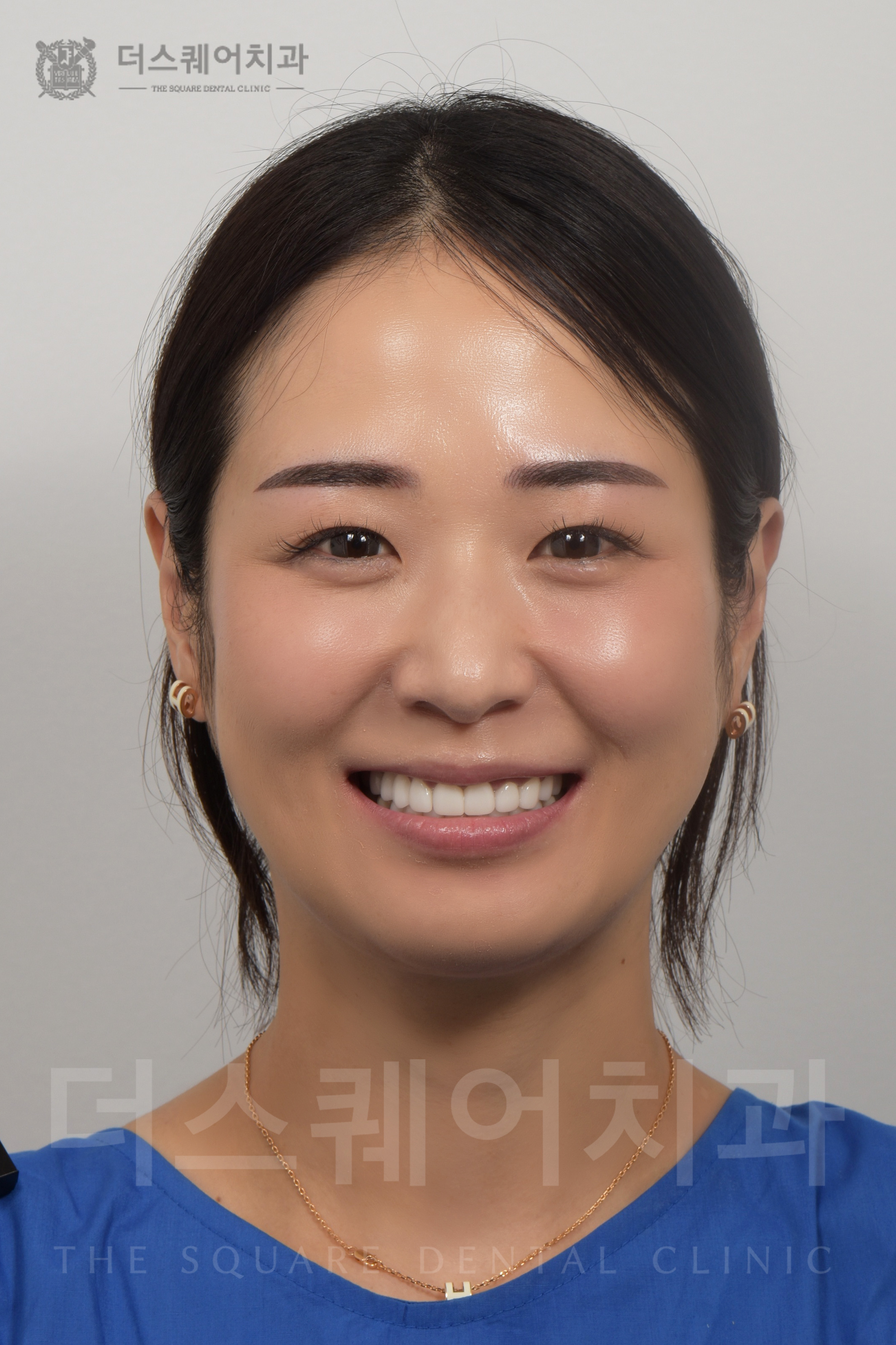 損傷・変色した歯の修復を目的としたベニアキューブ審美治療