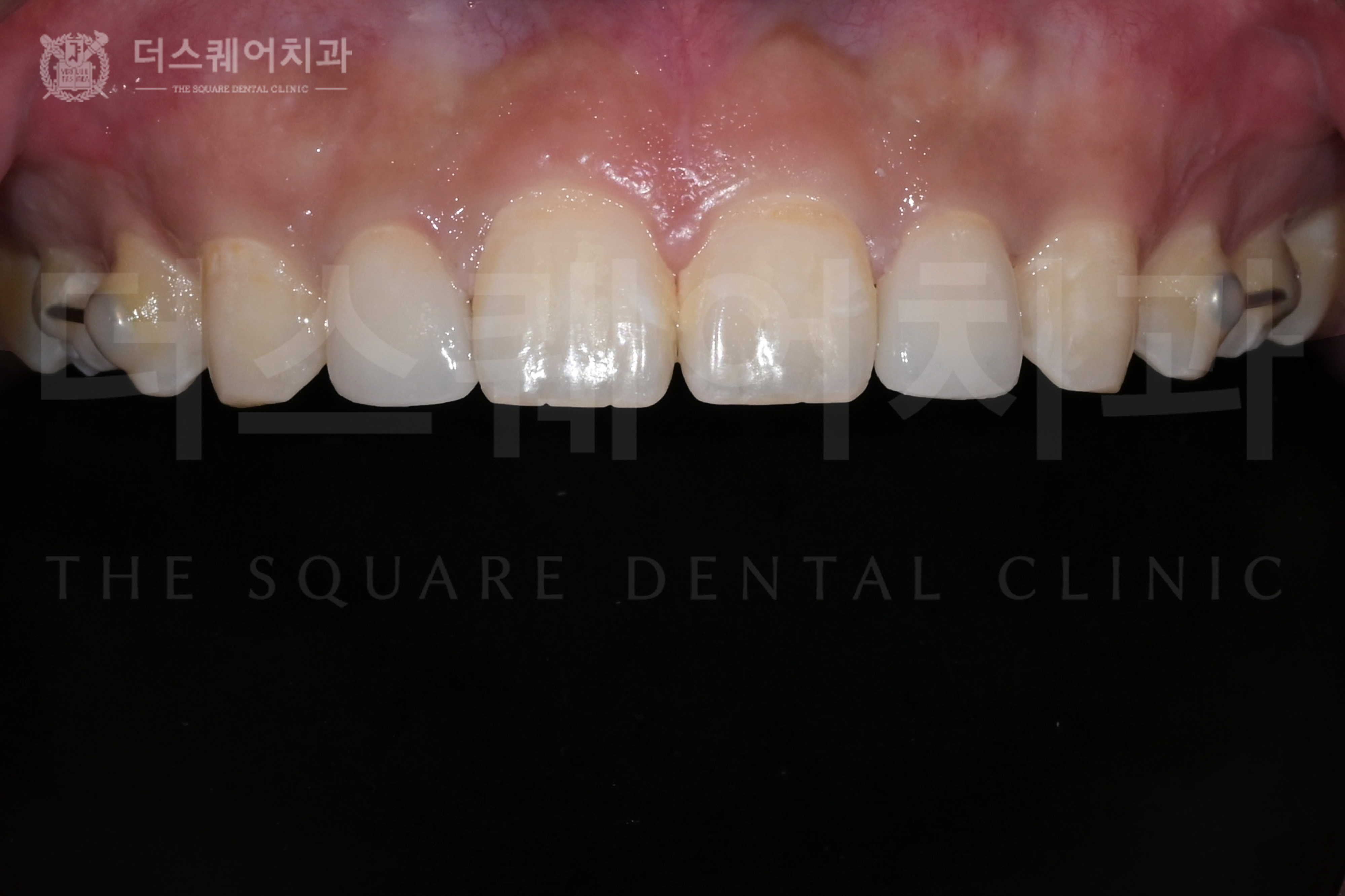 <br />
<b>Warning</b>:  Undefined variable $ba_title in <b>/home/thesquaredc.co.kr/clinical-case/clinicalcase.php</b> on line <b>608</b><br />

