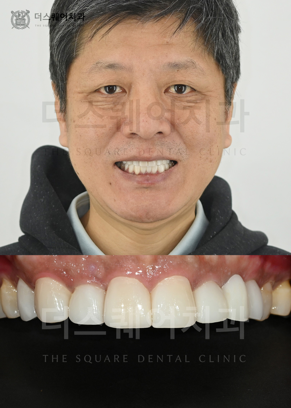 상하악 미니쉬로 노화된 치아의 배열과 색상을 해결한 케이스