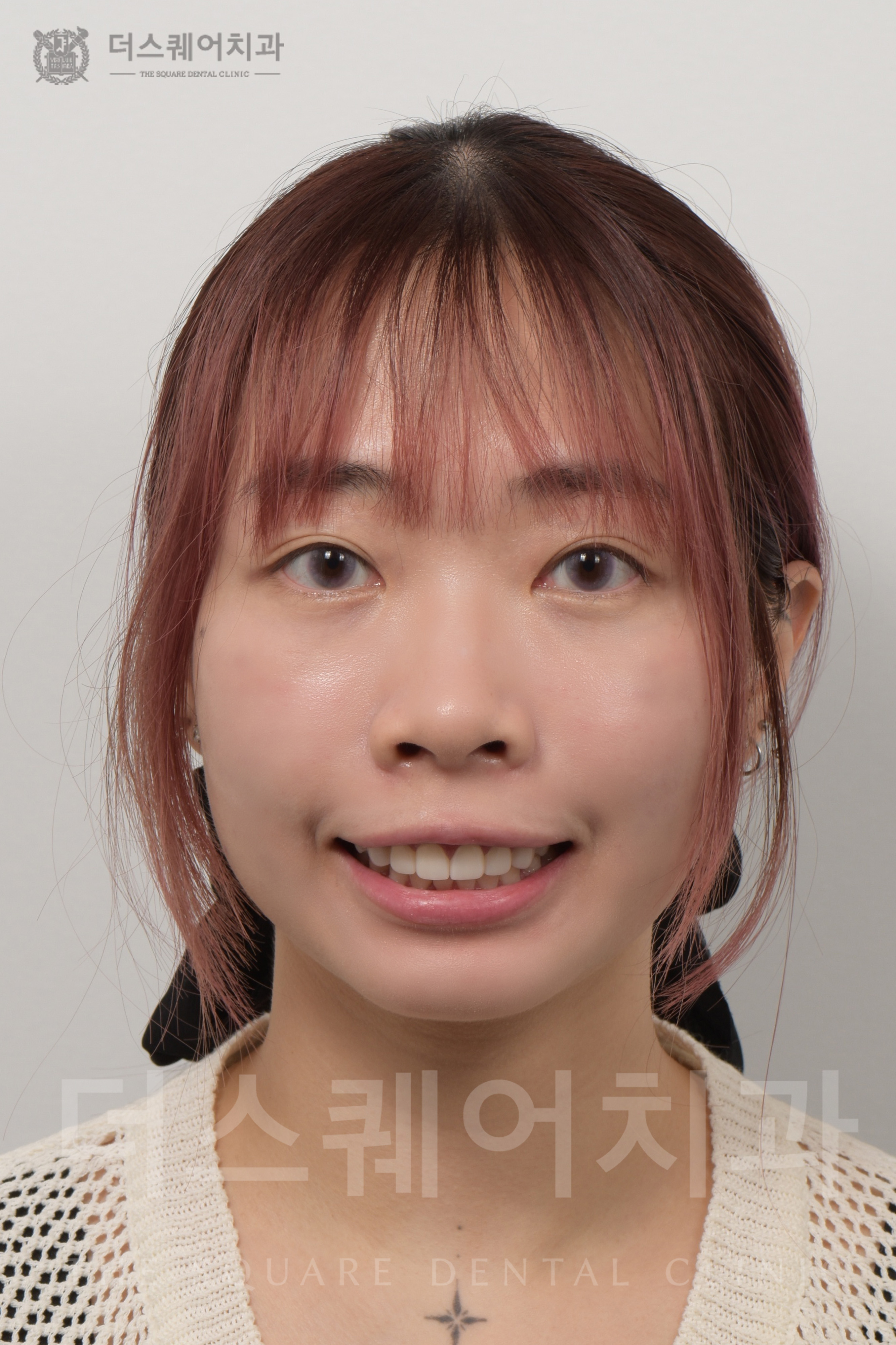 変色・損傷した歯の修復を目的としたミニッシュ審美治療