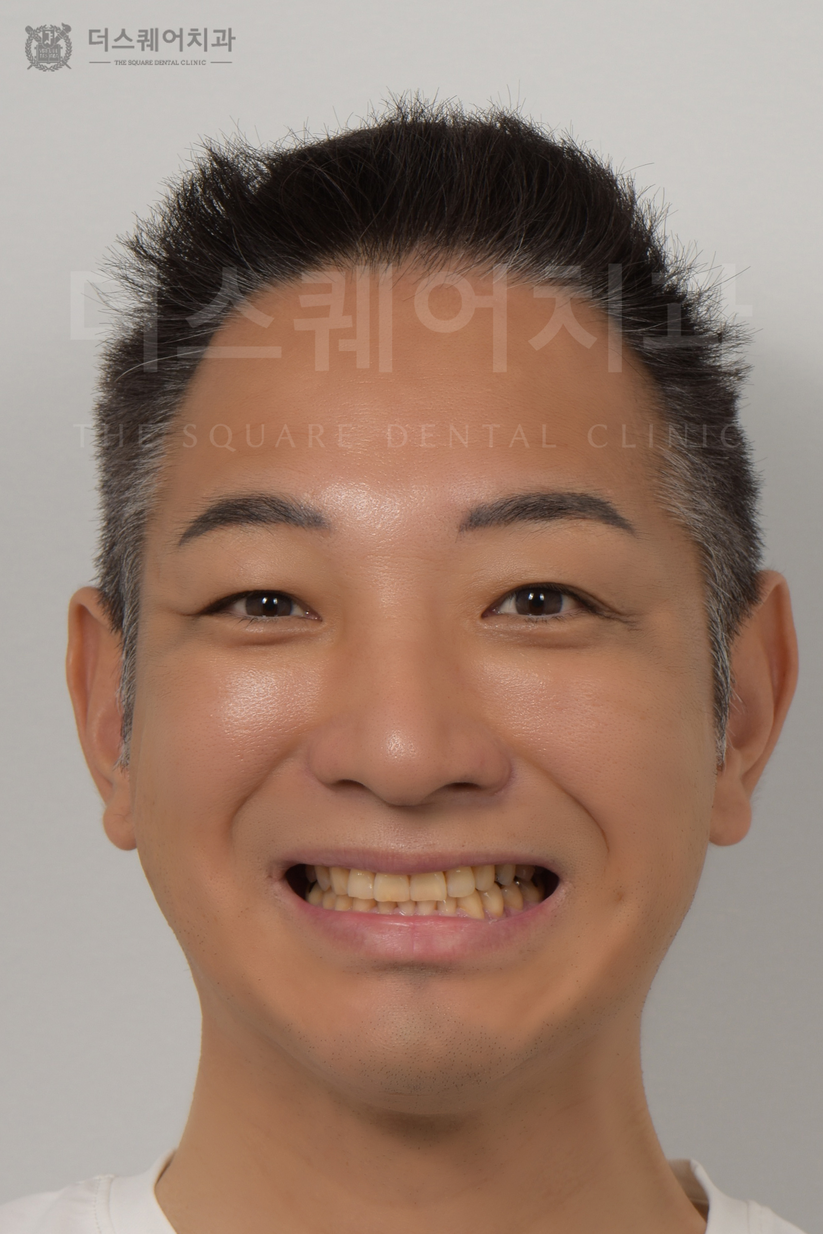 損傷・変色・歯並びの乱れを改善するためのベニアキューブ審美治療