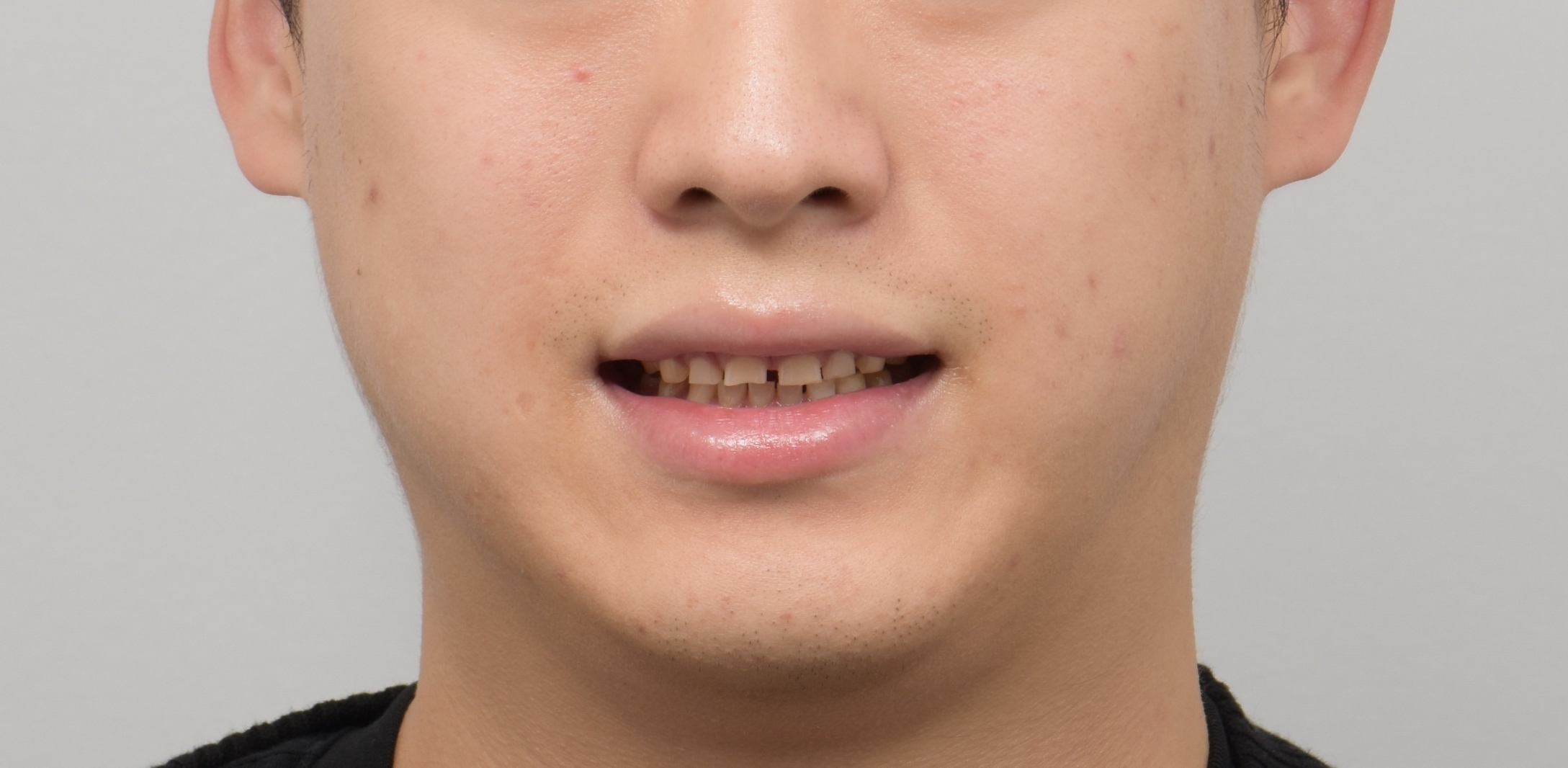 선천적 마모 및 벌어진 치아복구 