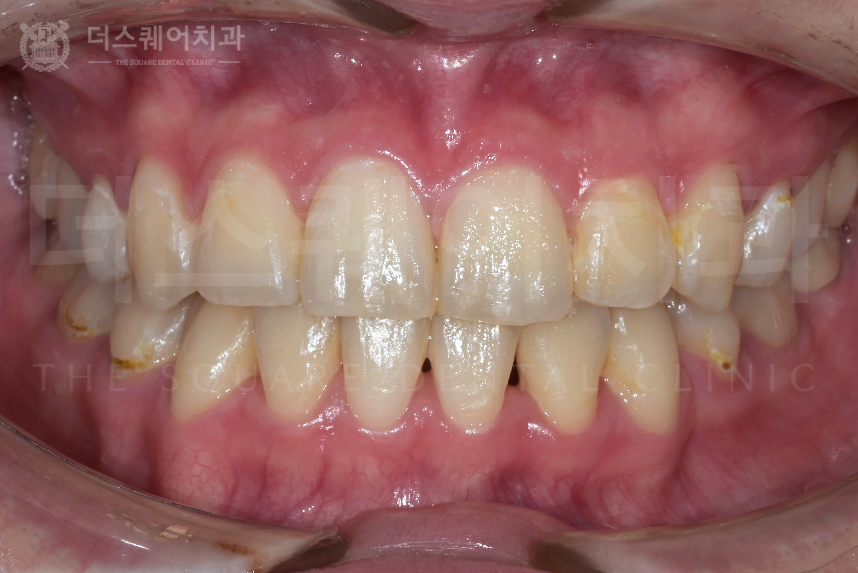 <br />
<b>Warning</b>:  Undefined variable $ba_title in <b>/home/thesquaredc.co.kr/clinical-case/clinicalcase.php</b> on line <b>608</b><br />
