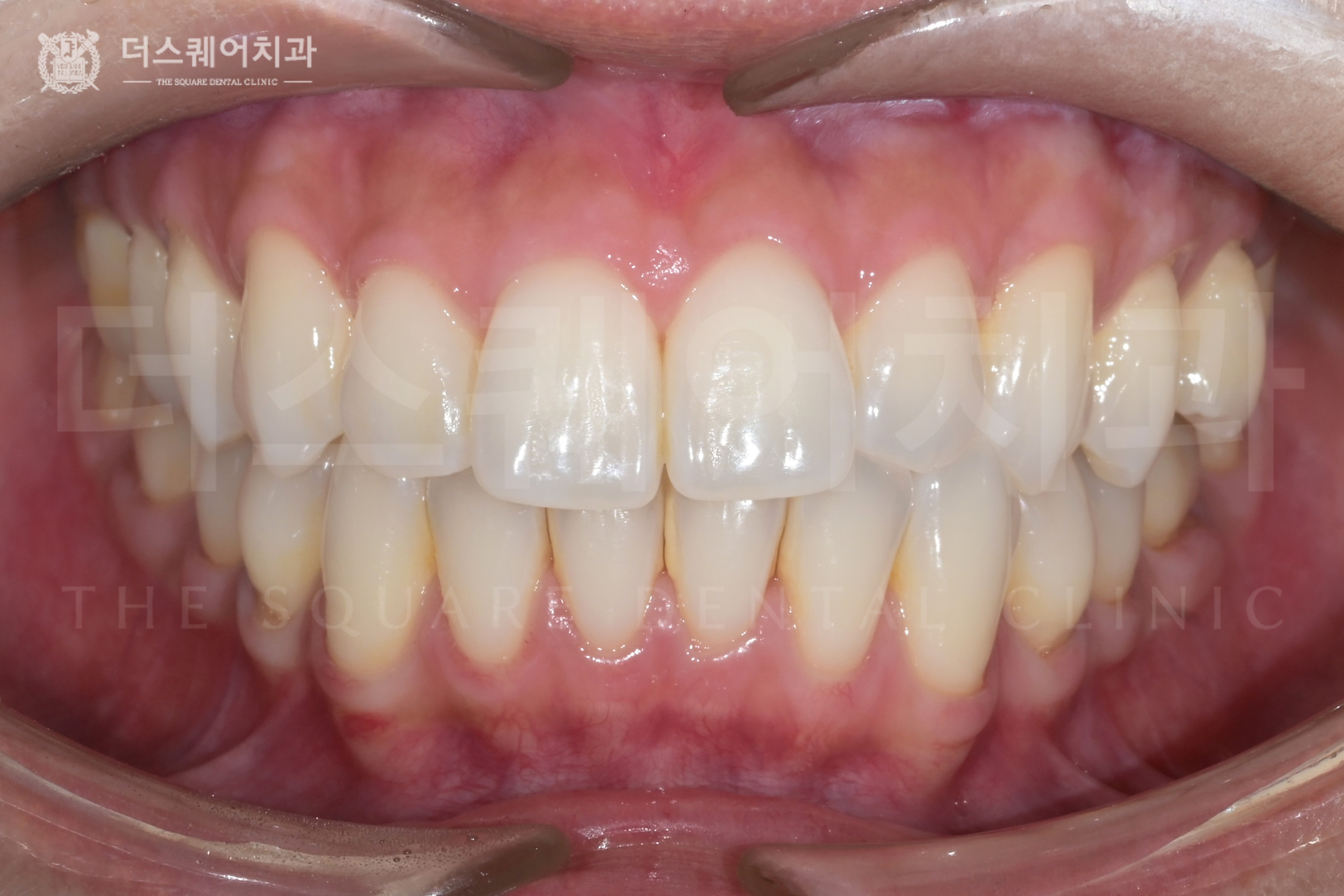 치아의 자연스러운 밝기를 되찾는 치아미백