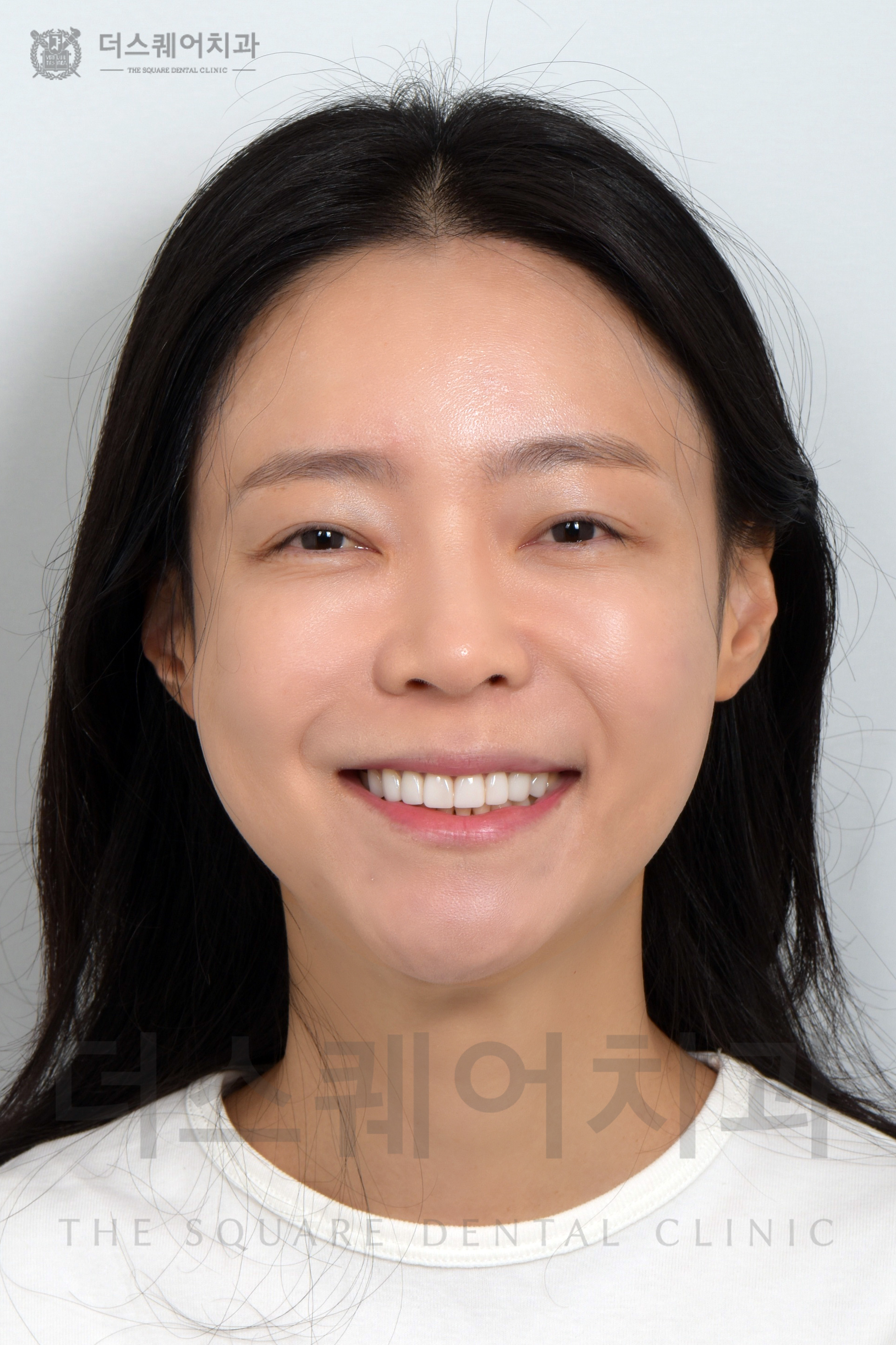 앞니 재치료, 변색, 손상된 치아 복구를 위한 미니쉬 심미치료