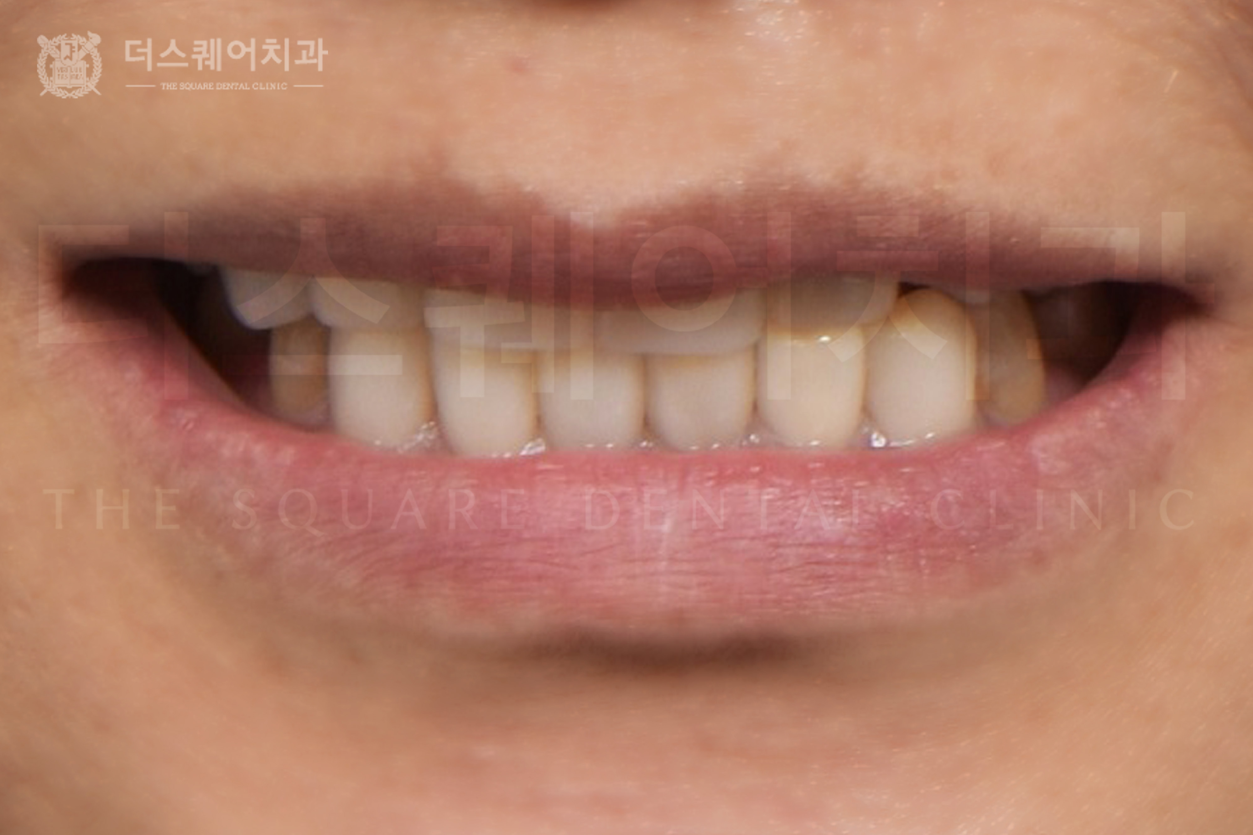 <br />
<b>Warning</b>:  Undefined variable $ba_title in <b>/home/thesquaredc.co.kr/clinical-case/clinicalcase.php</b> on line <b>608</b><br />
