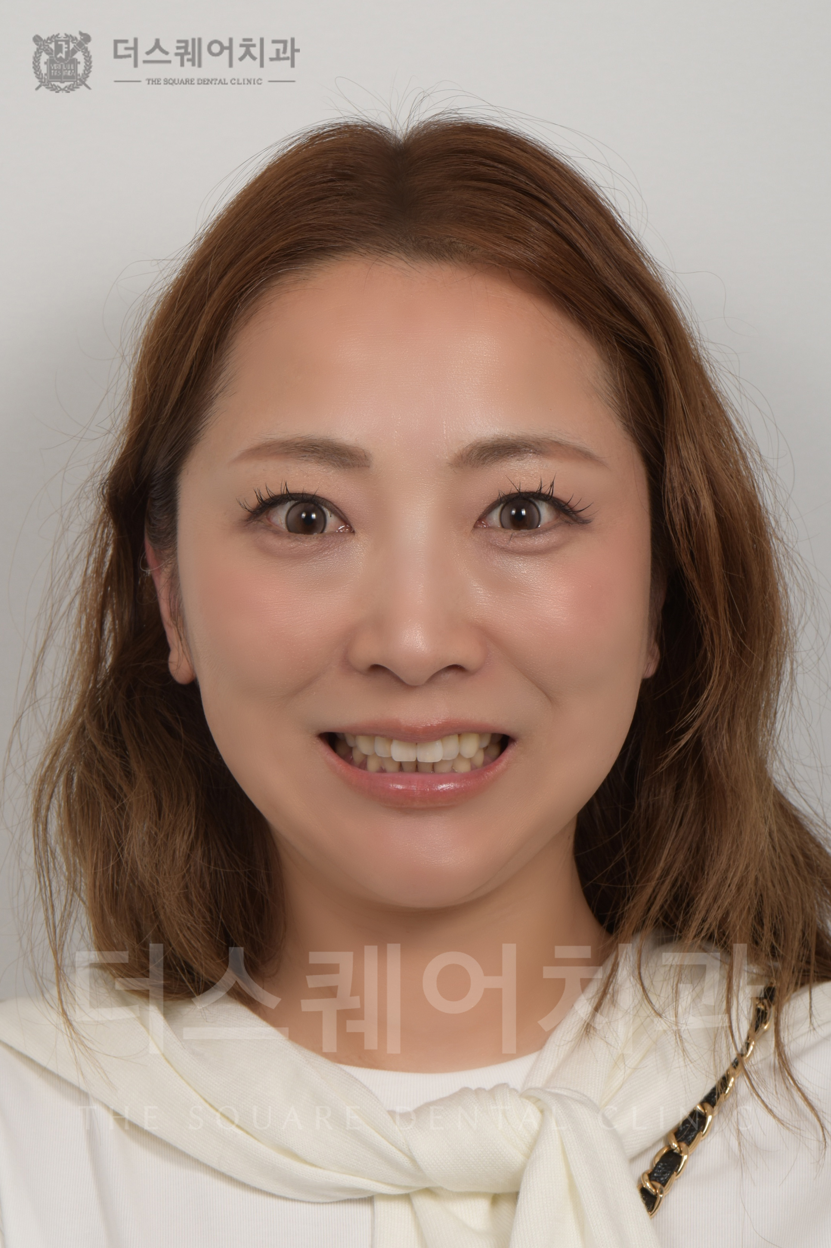 변색, 배열, 블랙트라이앵글 , 손상된 치아 복구를 위한 비니어큐브 심미치료