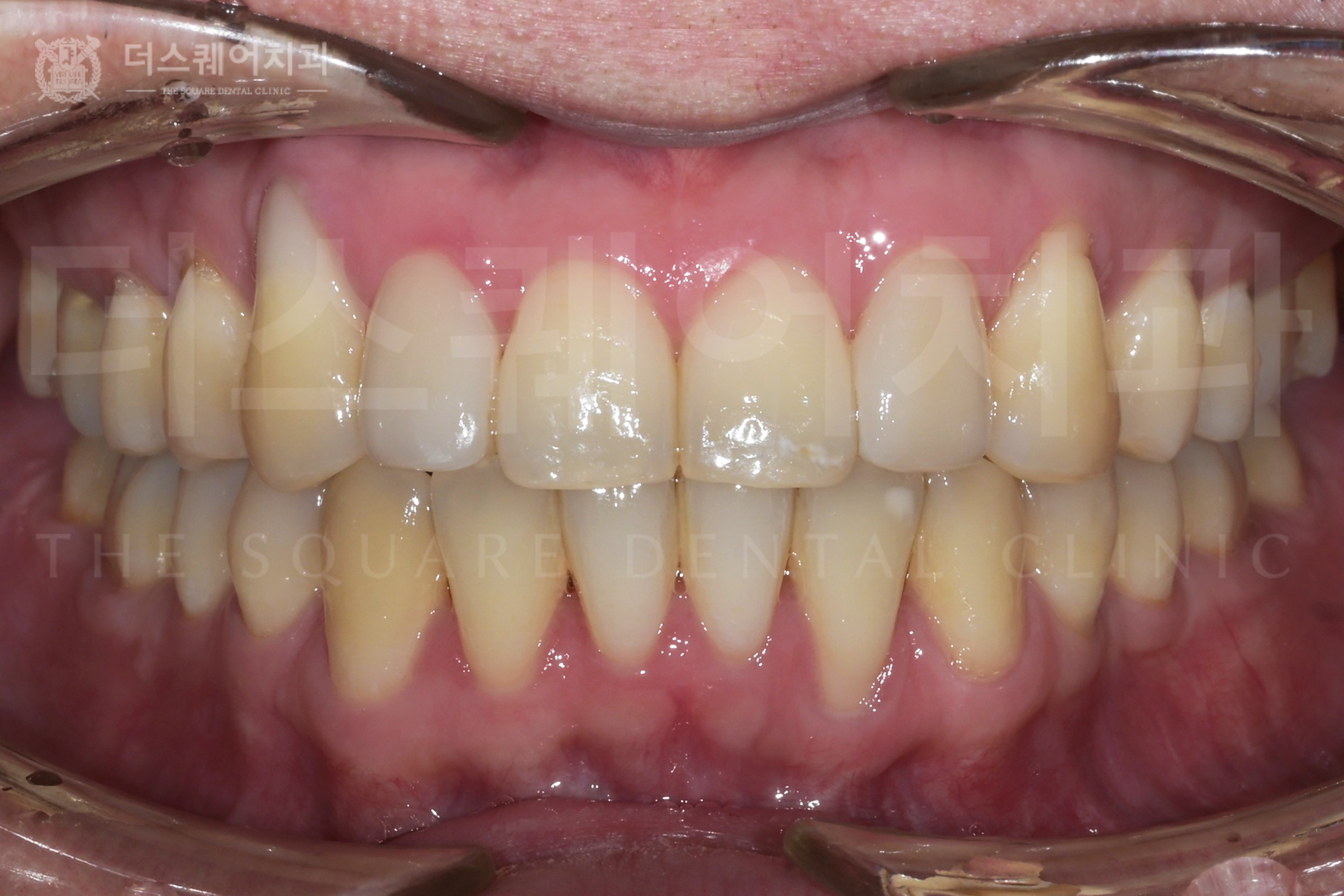 <br />
<b>Warning</b>:  Undefined variable $ba_title in <b>/home/thesquaredc.co.kr/clinical-case/clinicalcase.php</b> on line <b>608</b><br />
