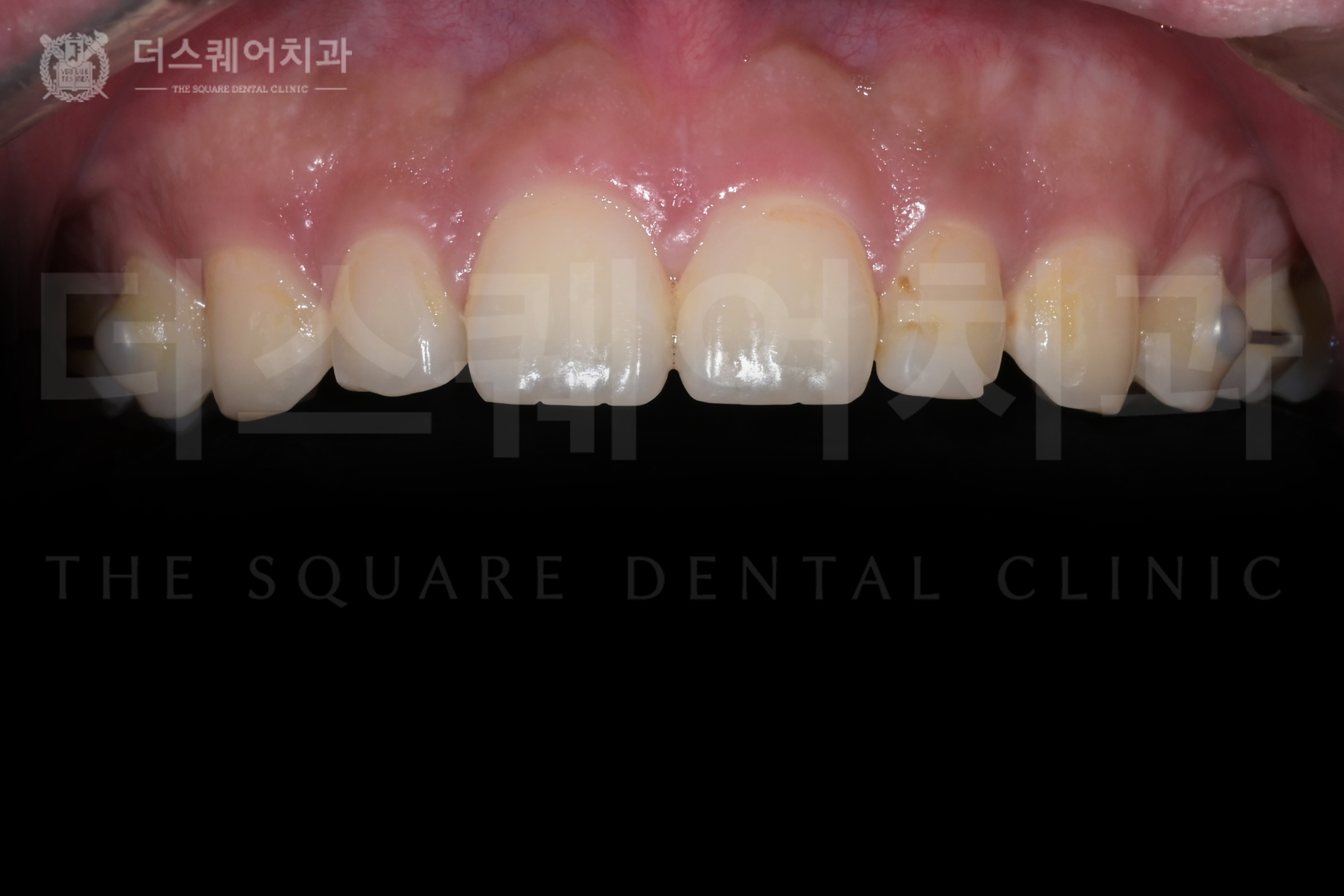 왜소치 · 손상된 앞니, 미니쉬 복구