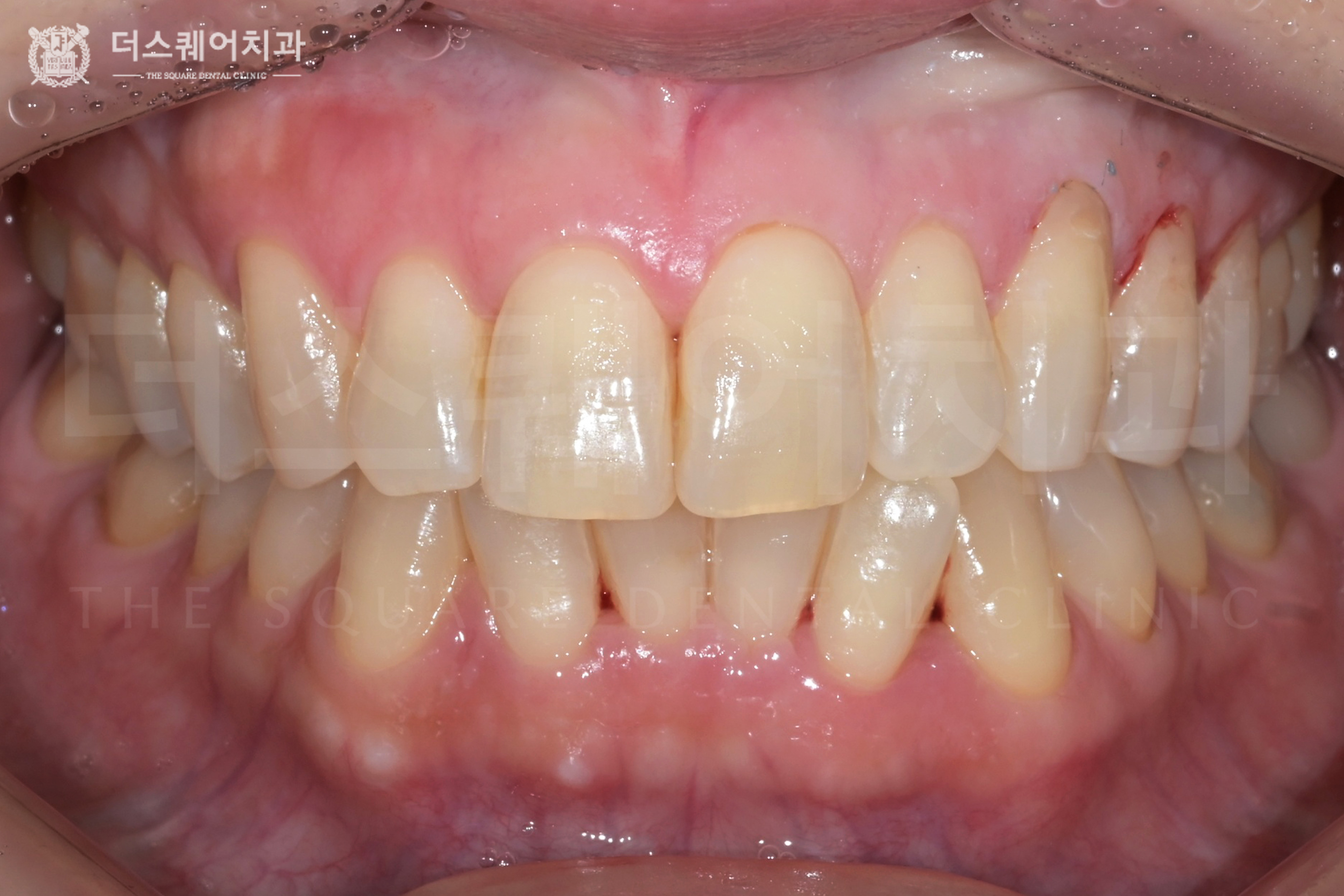균일하고 밝은 치아를 위한 치아미백