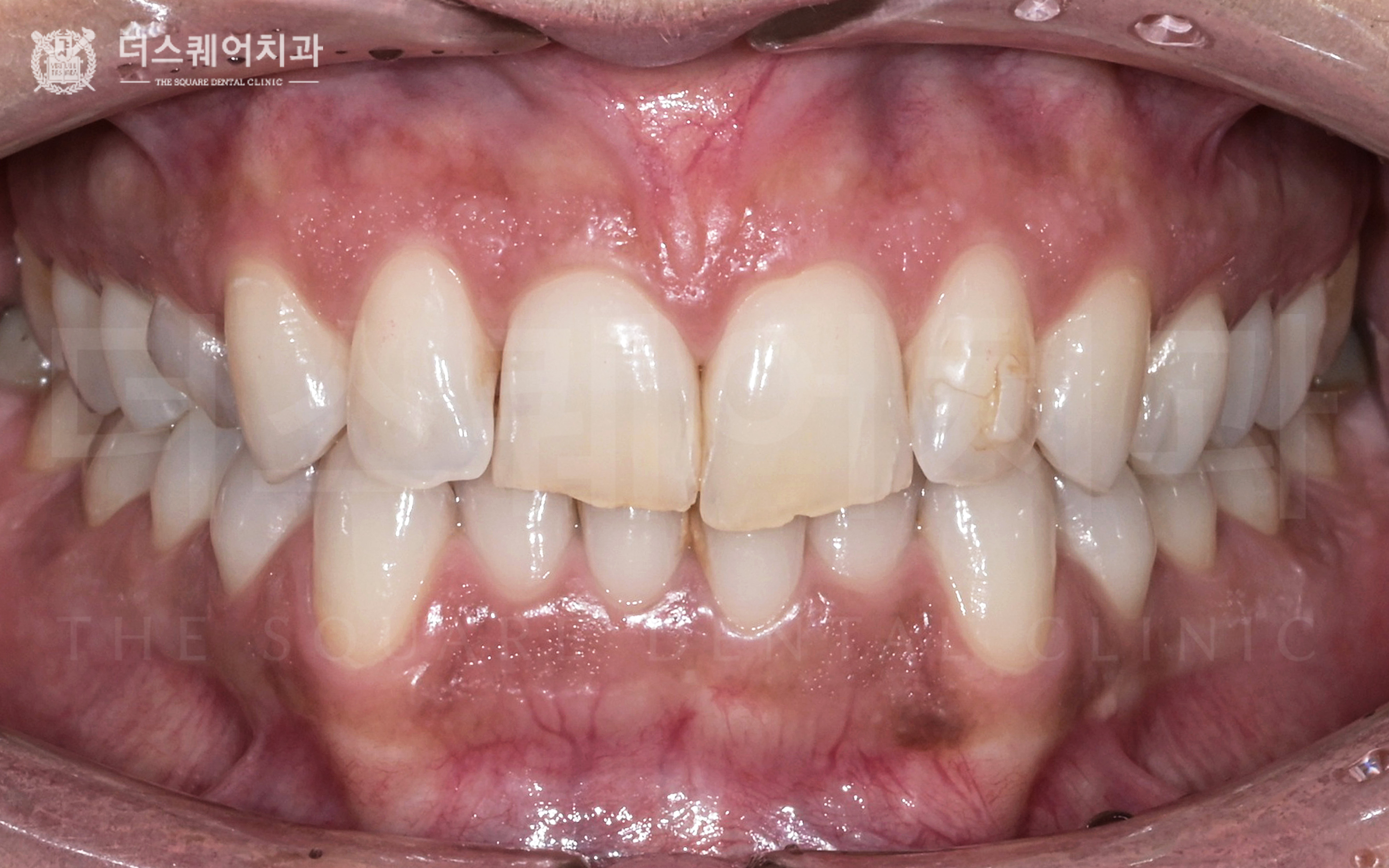 변색, 손상된 치아 복구를 위한 비니어큐브 심미치료