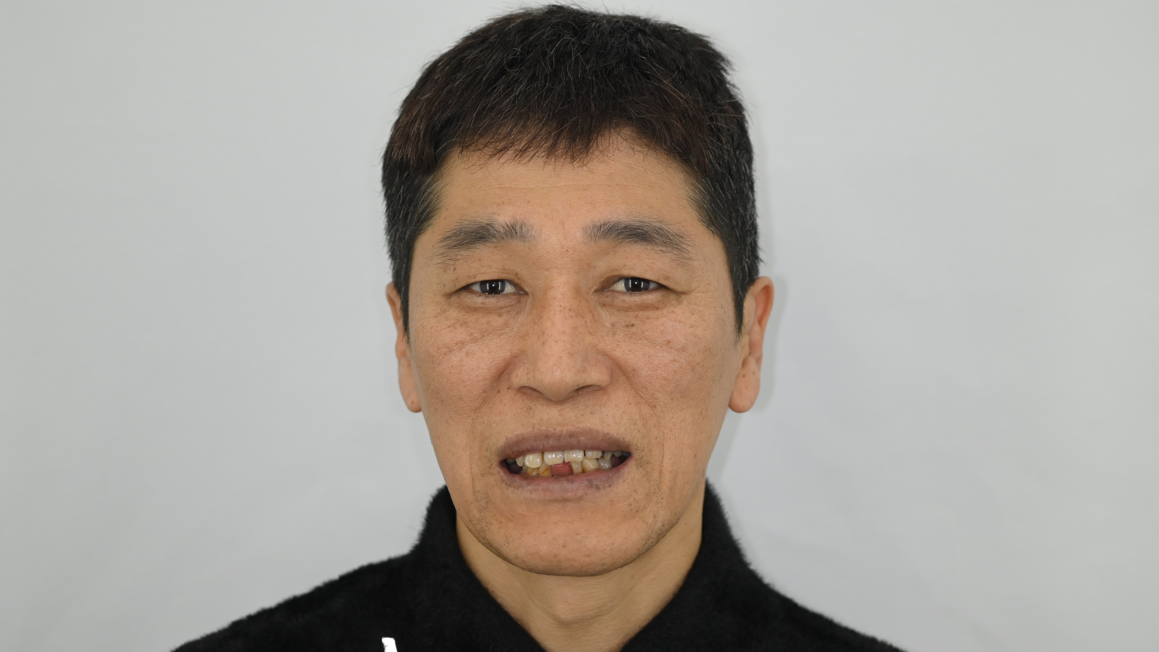 전체 임플란트를 통한 기능 및 얼굴 재건