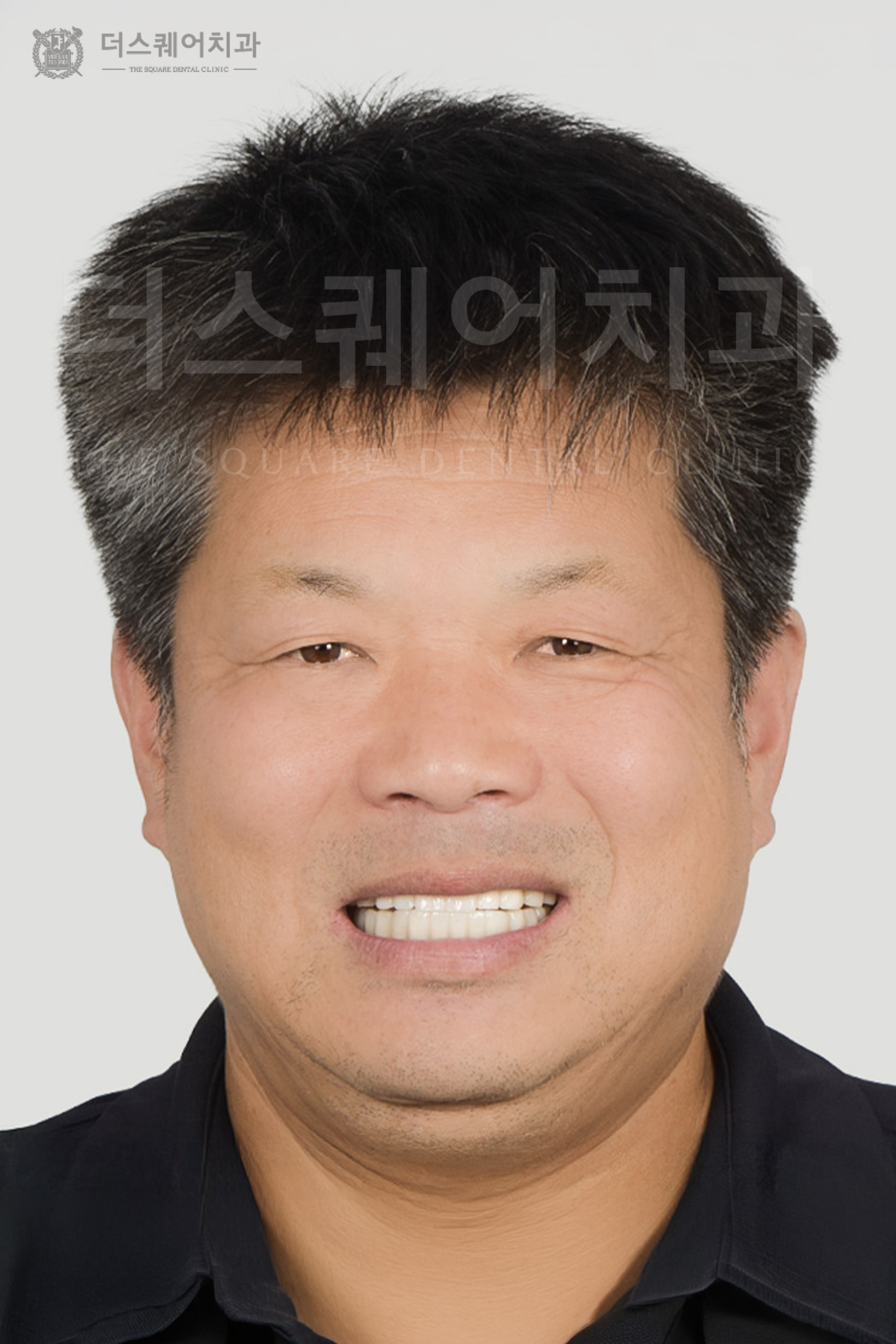 전체 임플란트로 회복한 치아와 안모변화