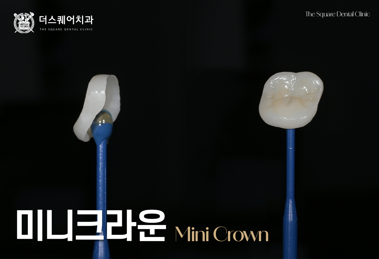 크라운 진단 받았지만 치아는 건강하다면?