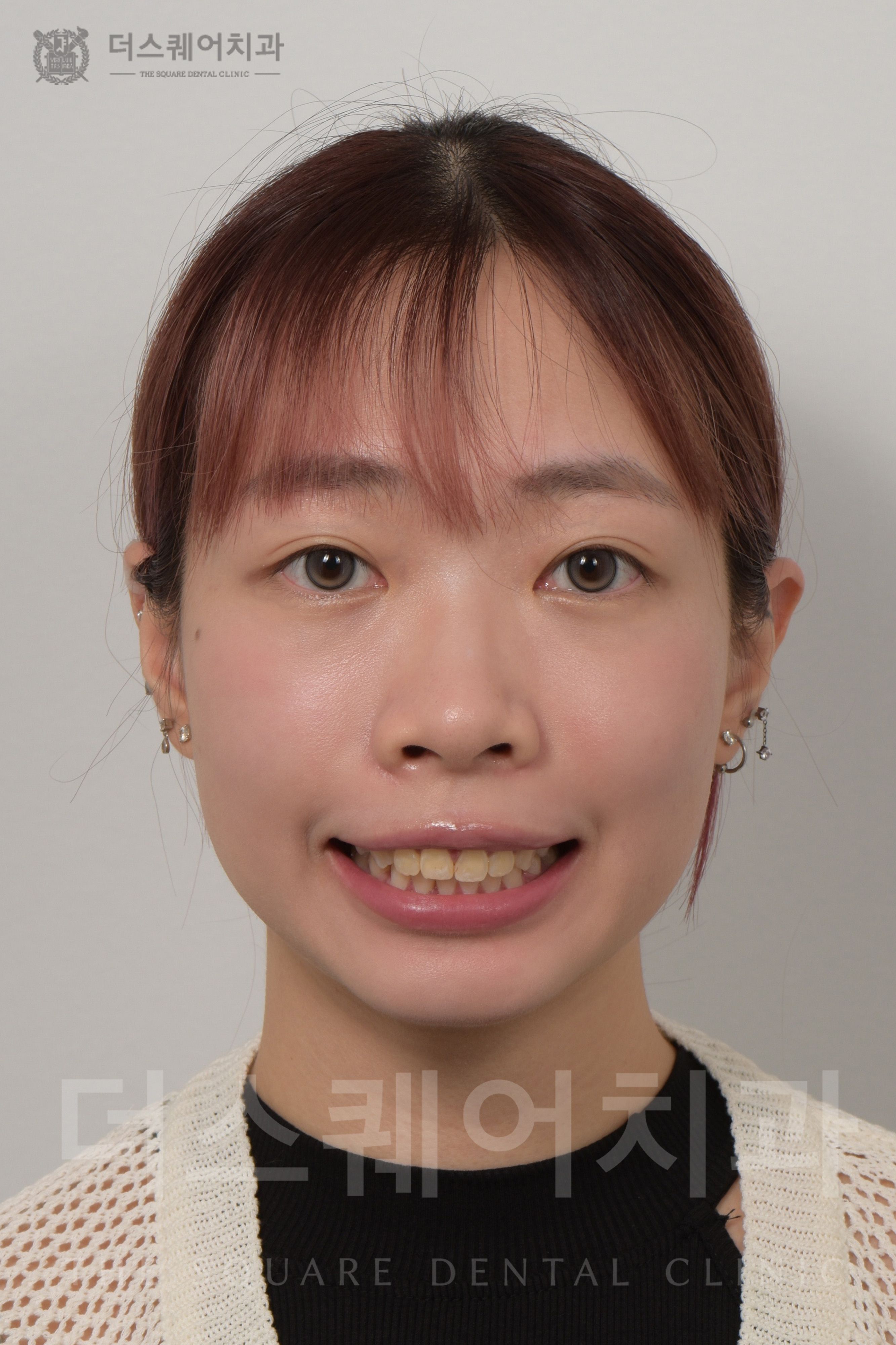変色・損傷した歯の修復を目的としたミニッシュ審美治療